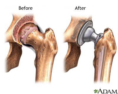 [인공관절, 관절염, 고관절]Hip Joint(Before / After)